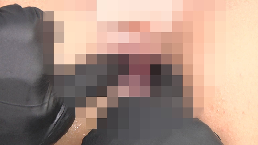 尻穴拡張クリニック 臨床手順に基づくアナル拡張記録 画像8